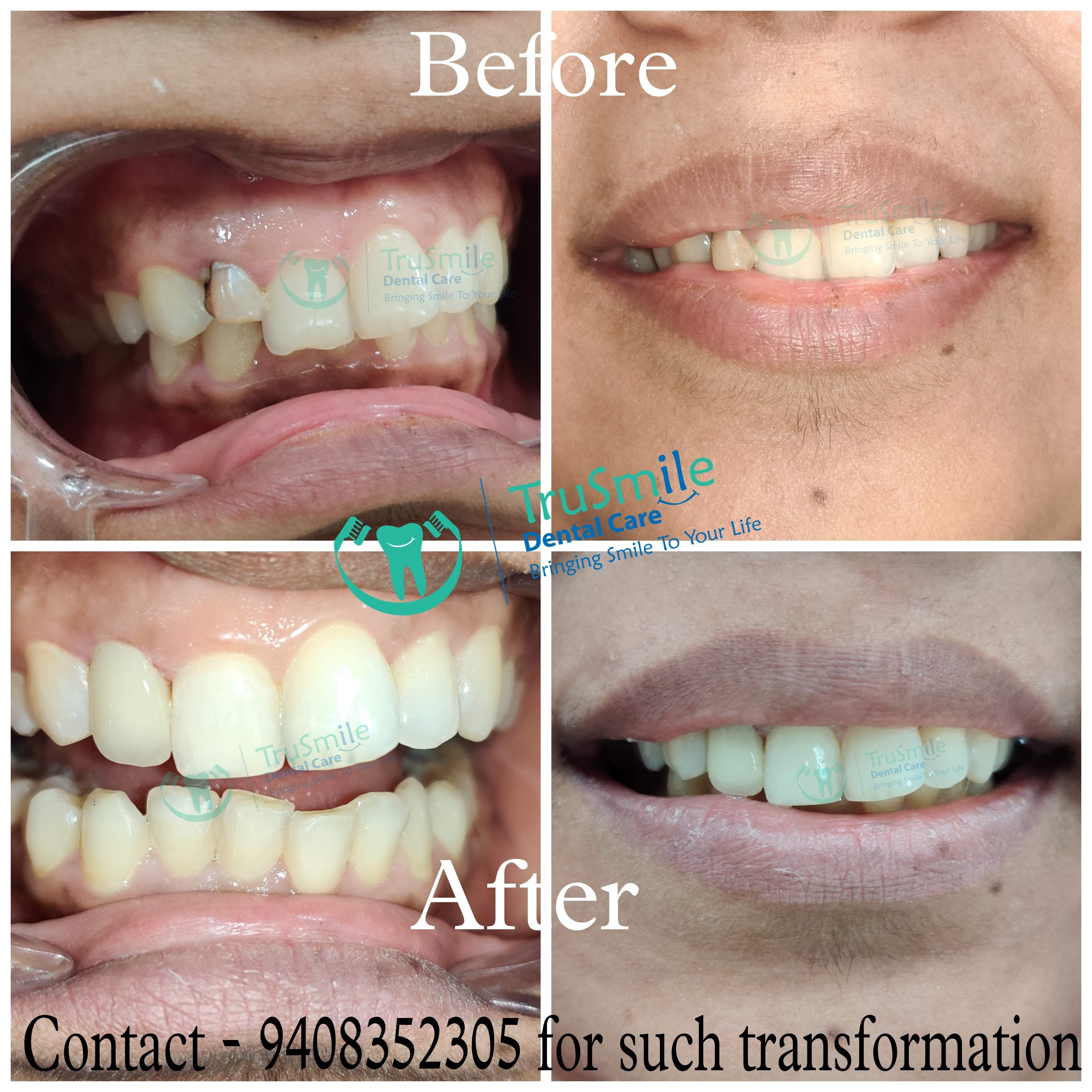 Zirconia 5